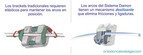 Ortodoncia Málaga Damon