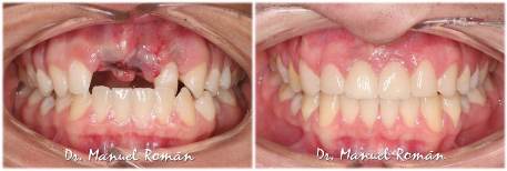 Ortodoncia Málaga Implantes