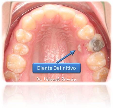 Ortodoncia Málaga Diente Leche