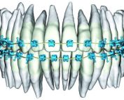 ¿Qué es SureSmile?