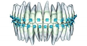 ¿Qué es SureSmile?