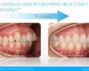 Tratamiento de la Clase II con el Sistema Invisalign™