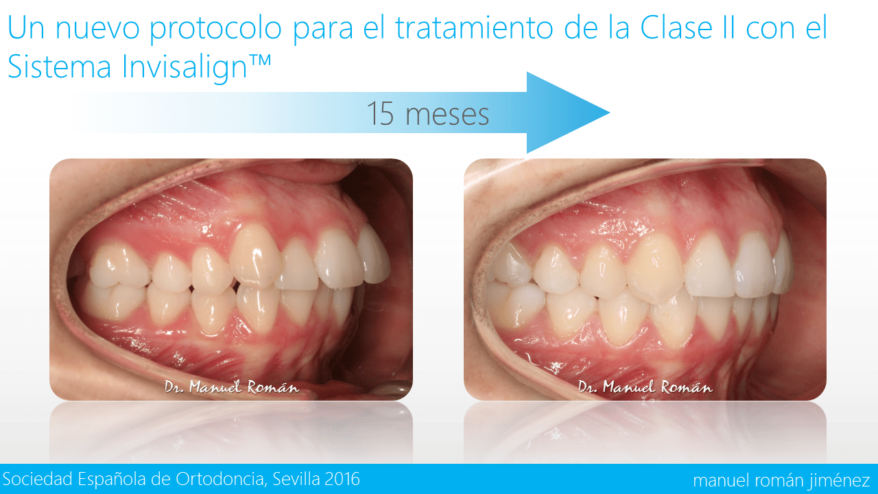 Tratamiento de la Clase II con el Sistema Invisalign™