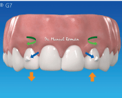 Nuevo Invisalign G7