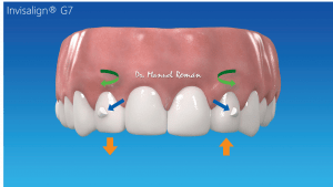 Nuevo Invisalign G7