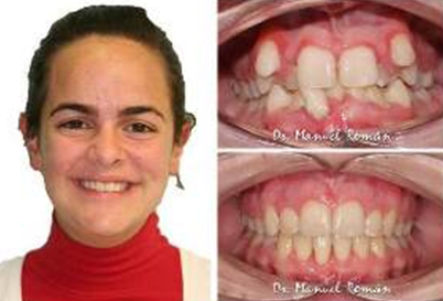 Ortodoncia Invisalign Málaga Apiñamiento extremo