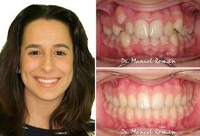 Ortodoncia Invisalign Málaga Clase II