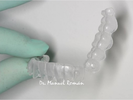 Invisalign Málaga