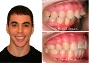 Biprotrusion dental Adolescentes