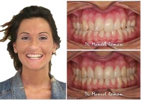 Mordida Cruzada con Invisalign – Adultos