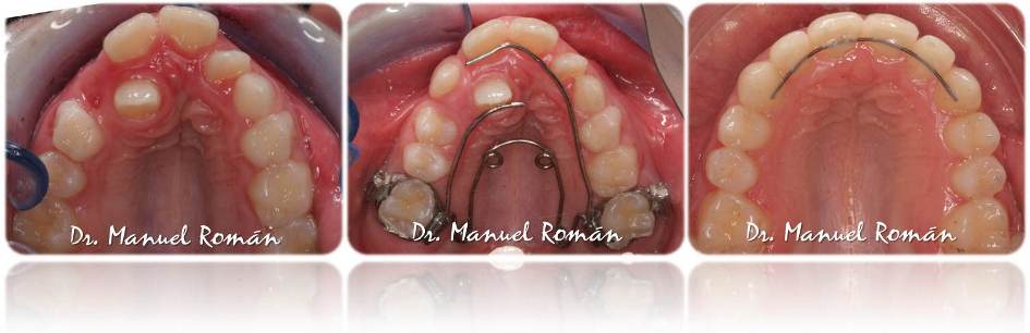 caso clinico quad helix