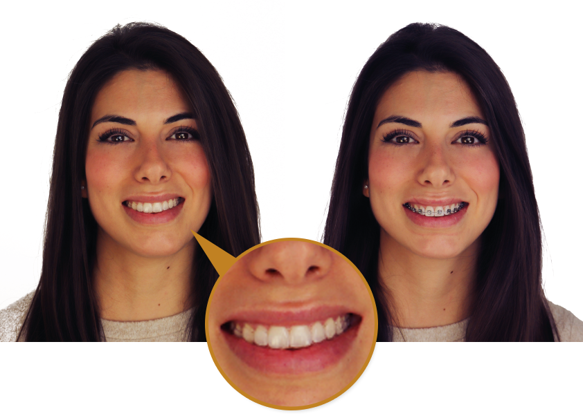 Invisalign Comparación