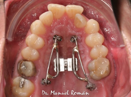 Ortodoncia Málaga Microtornillos