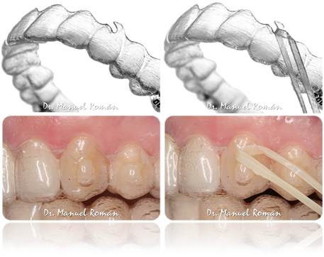 Ganchos o Hooks Invisalign