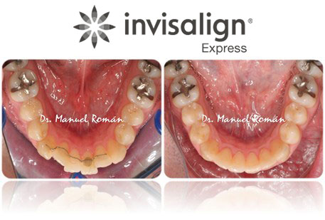 invisalign-express