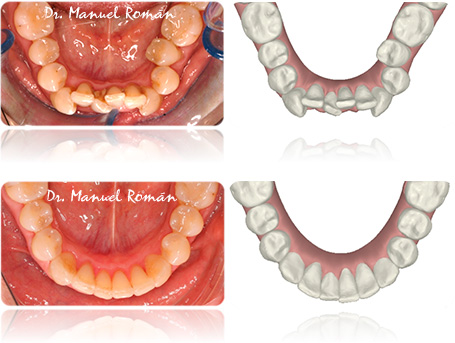 invisalign antes y despues