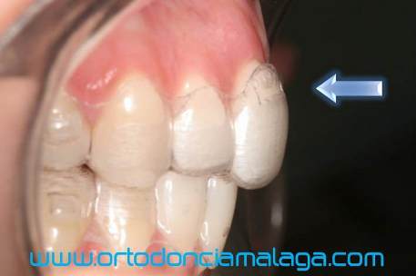 invisalign power ridges Málaga