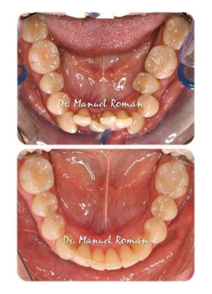 maloclusion apinamiento