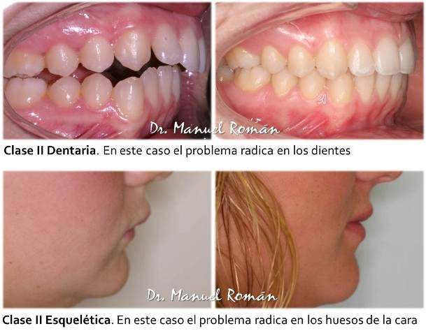 maloclusion clase2