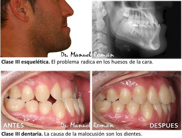 maloclusion clase3