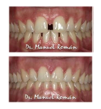 maloclusion diastemas