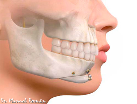 Mentoplastia y Ortodoncia Málaga