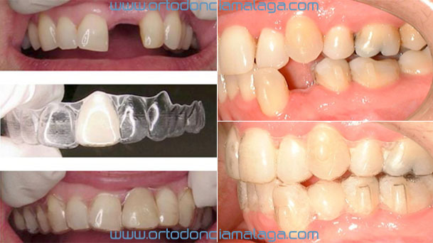 Ponticos con Invisalign