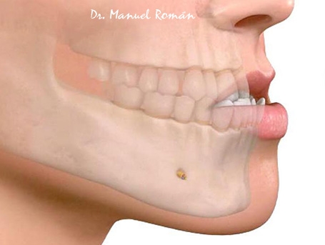 Prognatismo Mandibular o Clase 3 » Cirugía Ortognática - Instituto